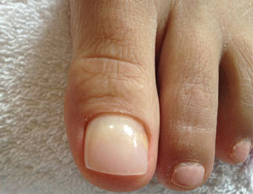 Rose-Bay-Podiatry_Keryflex-Treatment